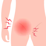 Cirugía de Hernias en Pachuca