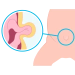 Cirugía de Hernias en Pachuca