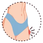 Cirugía de Hernias en Pachuca