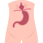 Cirugía de Hernias en Pachuca
