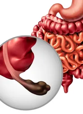 apendicitis Apendicetomía en Pachuca