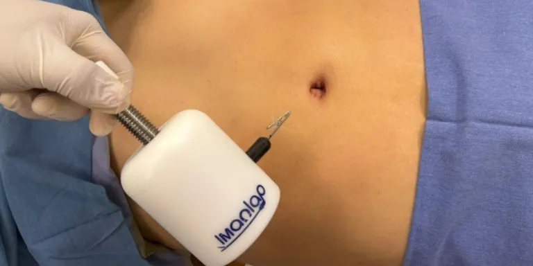 cirugia con iman Cirugía de Fístula Anal en Pachuca