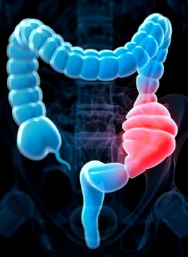 Especialista en Colitis en Pachuca