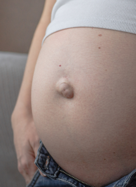 Cirugía de Hernia Umbilical en Pachuca