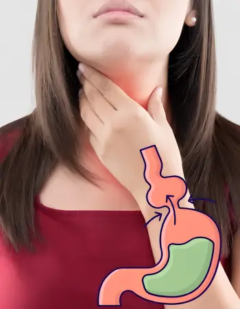 Cirugía de Hernia Hiatal en Pachuca