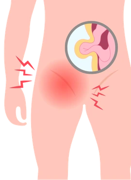 hernia ing Cirugía Robótica de Hernia Inguinal en Pachuca